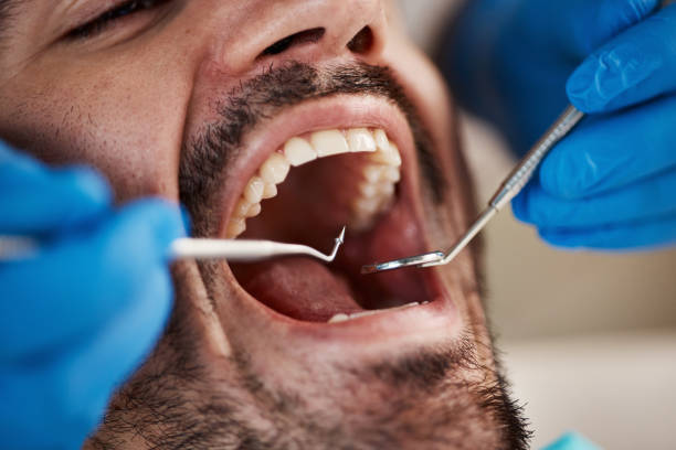 Best Emergency Dentist for Knocked-Out Tooth in Upton, WY